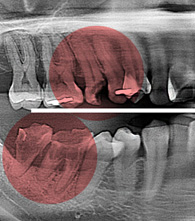 치주질환, 치주염