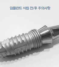 임플란트 전/후 주의사항