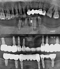 무치악 임플란트