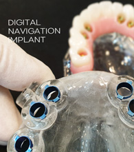 디지털 풀아치 임플란트