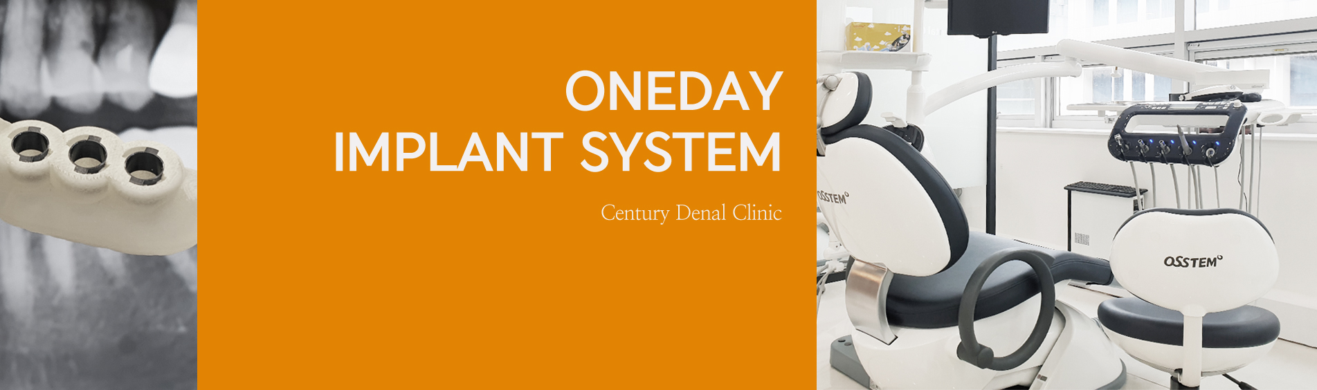 원데이 즉시식립 임플란트