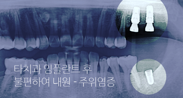 베스트e치과 네비게이션임플란트