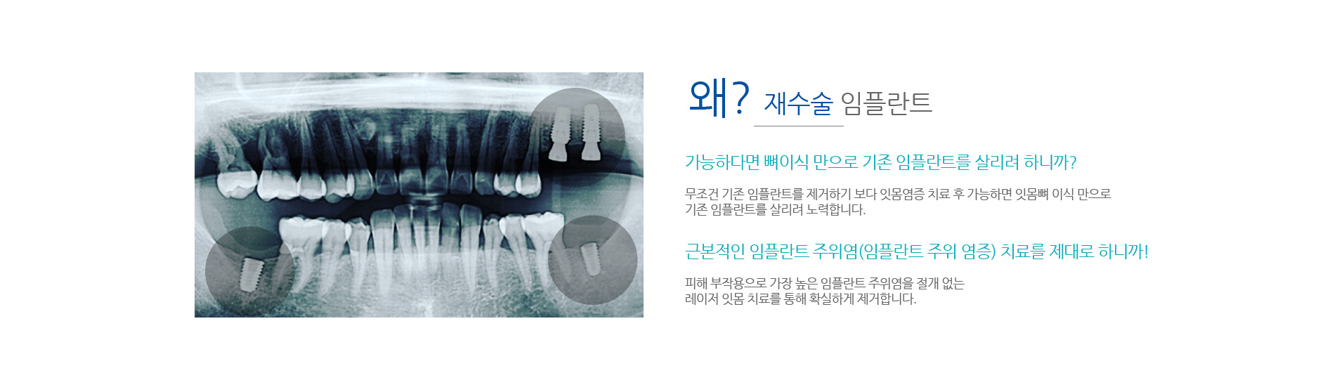 베스트e치과 임플란트재수술
