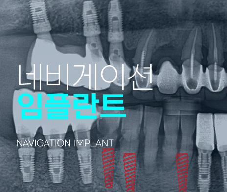 네비게이션 임플란트