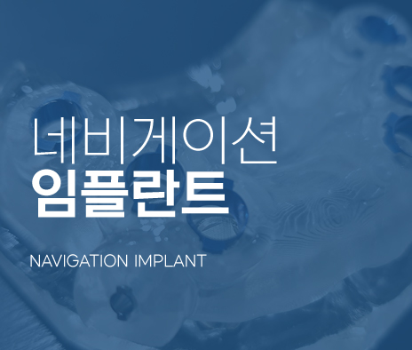 네비게이션 임플란트