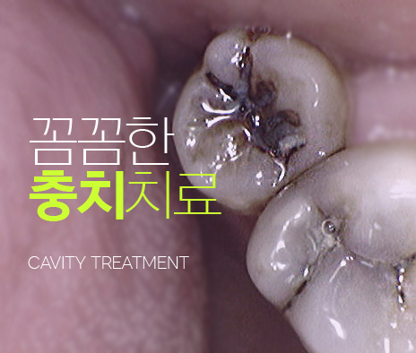 꼼꼼한 충치치료 