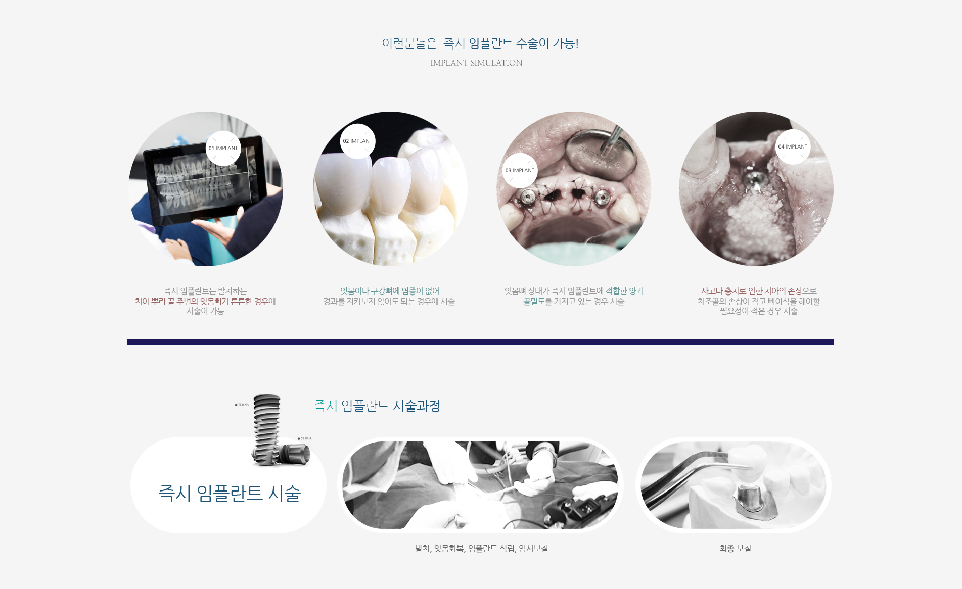 원데이 즉시식립 임플란트