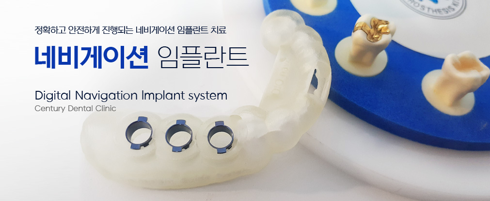 네비게이션 임플란트