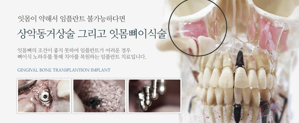 상악동 거상술/치조골 이식술