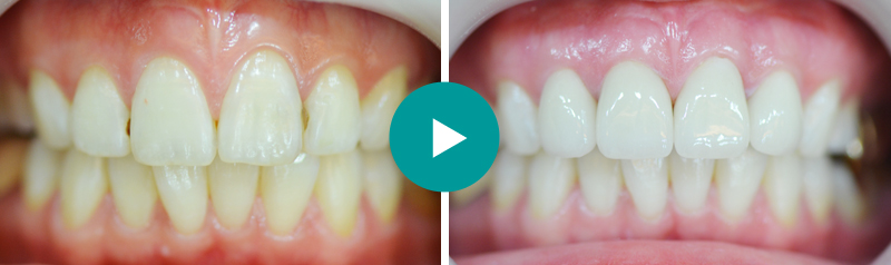 앞니성형  전/후