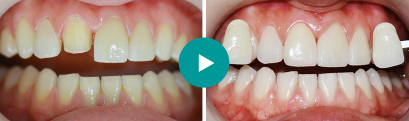 앞니성형  전/후