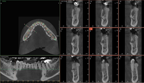 임플란트 재수술